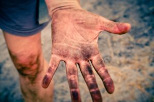 医療脱毛後に起こる肌トラブルとは？